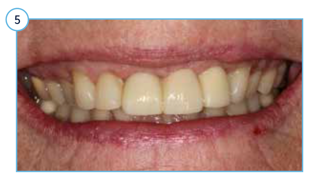 Clinical view of the aesthetic outcome one-year post restoration.
