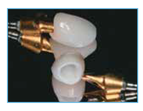  A close-up view of the IPS e.max glass-ceramic crowns and the BellaTek Gold-Colored Nitride Coated Abutment that were custom-fabricated for the case.