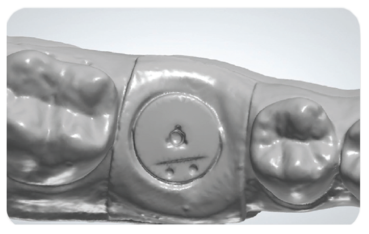encode emergence impression system intraoral scanning