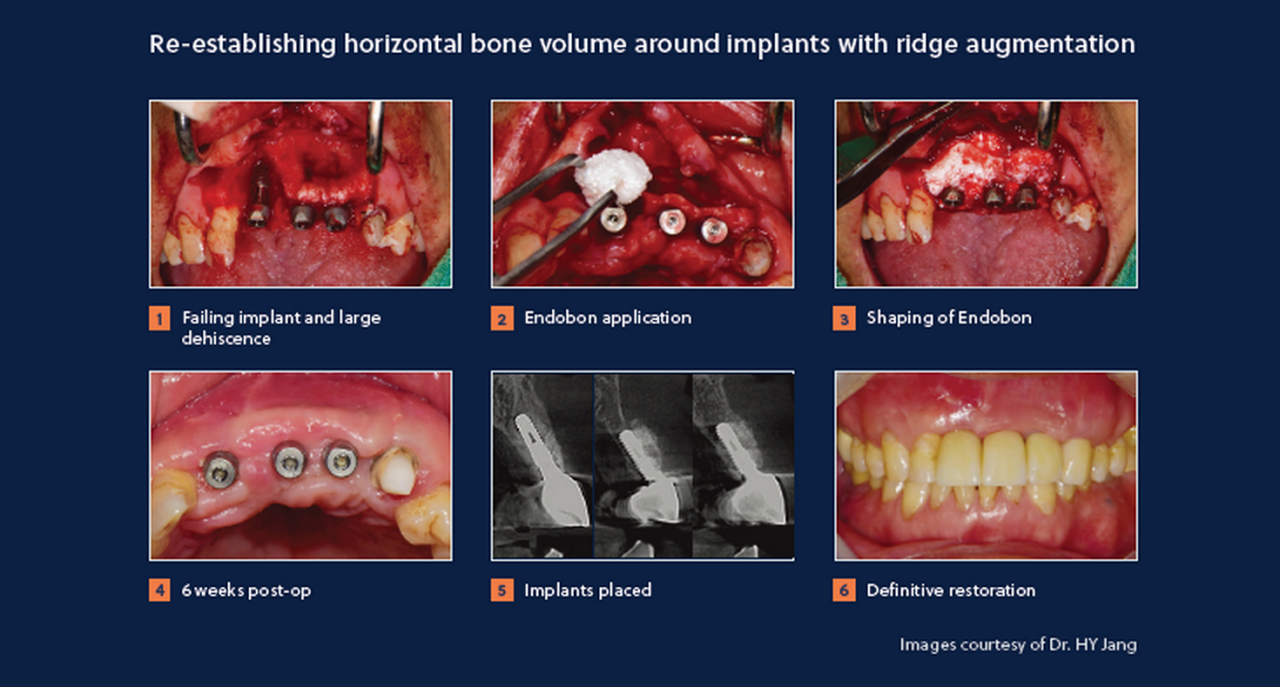Removal of failed implants with ridge augmentation