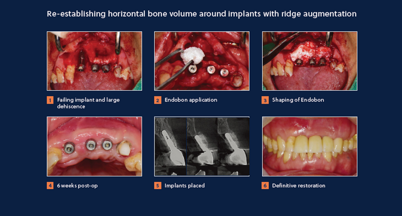 Removal of failed implants with ridge augmentation