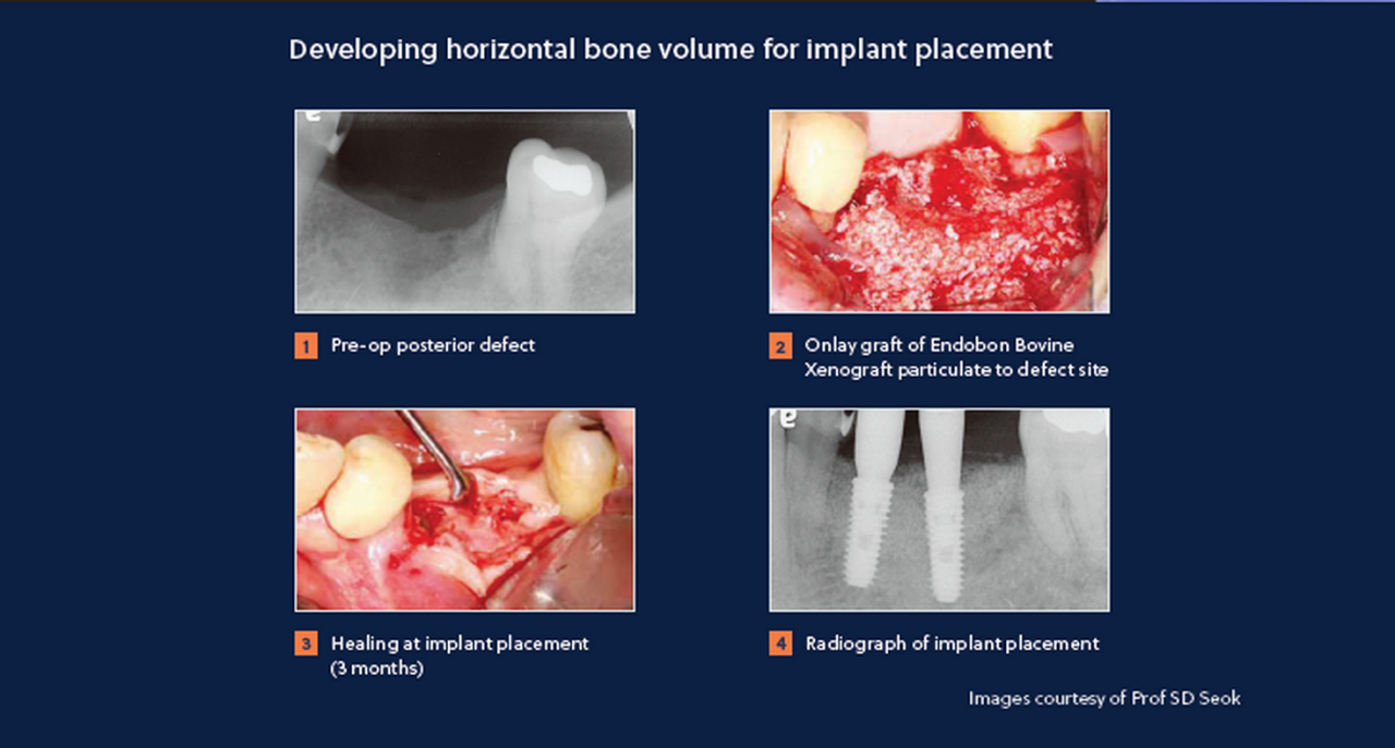 Removal of failed implants with ridge augmentation