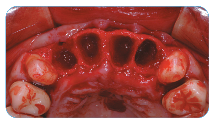 Fig. 1. Extraction sockets of the four maxillary incisors and immediate implant placement. Fig. 1. Extraction sockets of the four maxillary incisors and immediate implant placement.