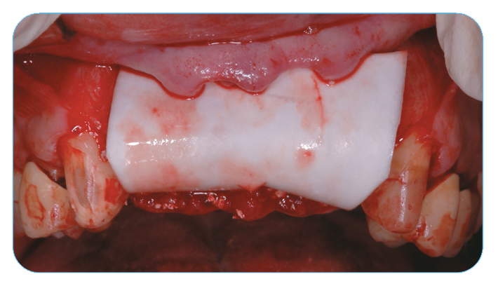Fig. 2. Grafting with Endobon Xenograft Small Granules covered by an OsseoGuard® Resorbable Collagen Membrane. Fig. 2. Grafting with Endobon Xenograft Small Granules covered by an OsseoGuard® Resorbable Collagen Membrane.