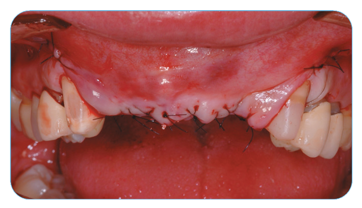 Fig. 3. The soft-tissue flaps were closed and sutured. Fig. 3. The soft-tissue flaps were closed and sutured.