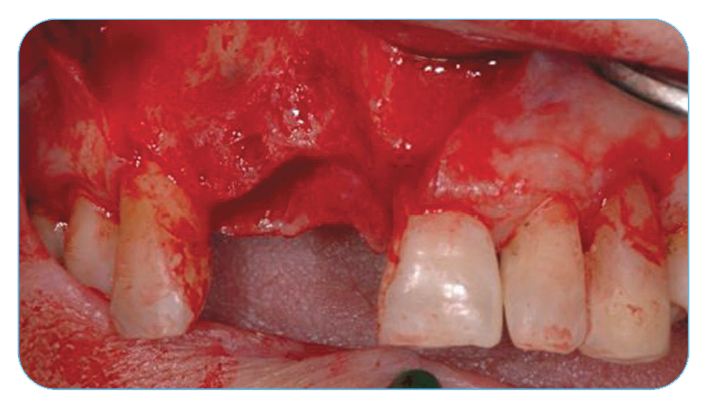 Fig. 7. Post-extraction defects in the maxilla right central and lateral incisor area. Fig. 7. Post-extraction defects in the maxilla right central and lateral incisor area.