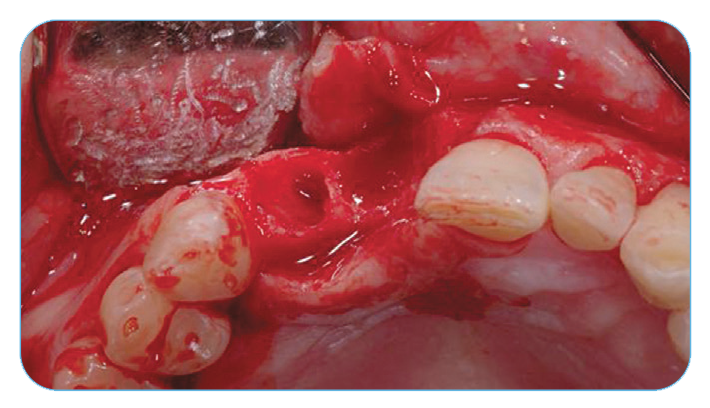 Fig. 8. Occlusal view of the extraction site defects.. Fig. 8. Occlusal view of the extraction site defects..