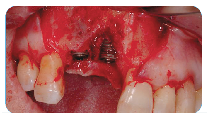 Fig. 9. Facial view of dehiscence defects after implant placement. Fig. 9. Facial view of dehiscence defects after implant placement.