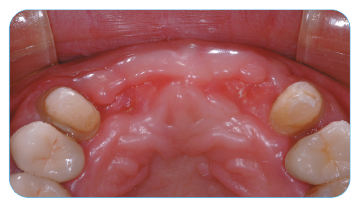 Fig. 4. Clinical appearance of soft tissue showing excellent soft-tissue healing after four months. Fig. 4. Clinical appearance of soft tissue showing excellent soft-tissue healing after four months.