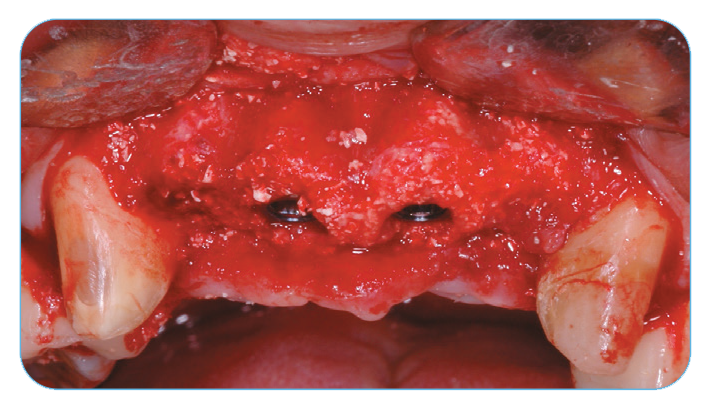 Fig. 5. Clinical appearance of the regenerated site at four months, after removing the remnants of the membrane.. Fig. 5. Clinical appearance of the regenerated site at four months, after removing the remnants of the membrane..