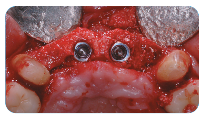 Fig. 6. Occlusal view after four months. Fig. 6. Occlusal view after four months.