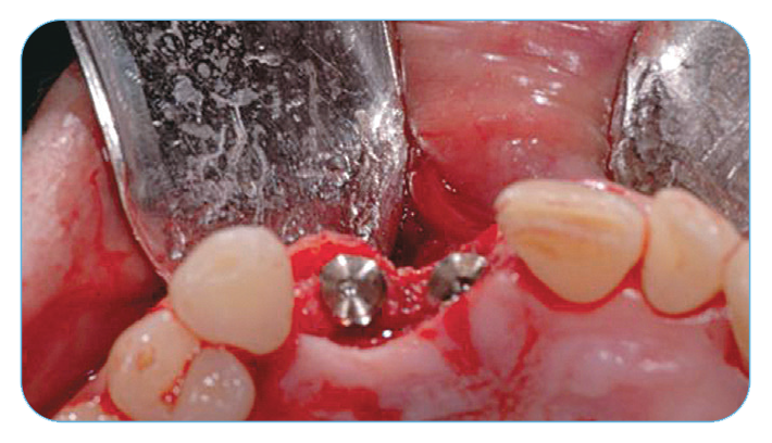 Fig. 10. Occlusal view of implants and defects. Fig. 10. Occlusal view of implants and defects.