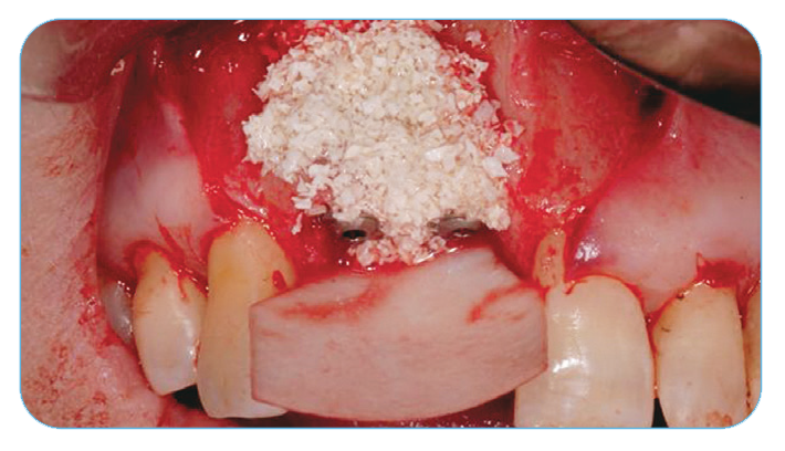 Fig. 11. Grafting with Endobon Xenograft Small Granules covered by an OsseoGuard Resorbable Collagen Membrane. Fig. 11. Grafting with Endobon Xenograft Small Granules covered by an OsseoGuard Resorbable Collagen Membrane.