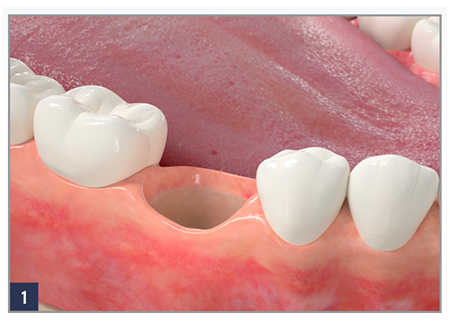 Fig.1 Place a RegenerOss Bone Graft Plug immediately after an extraction.