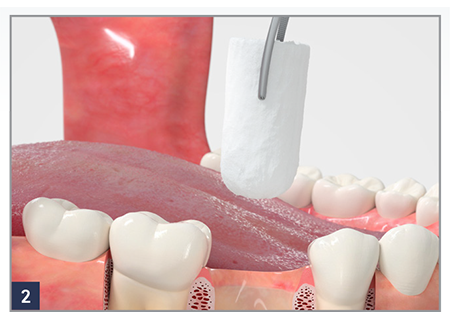 Fig.1 Place a RegenerOss Bone Graft Plug immediately after an extraction.