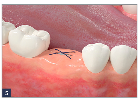 Fig.1 Place a RegenerOss Bone Graft Plug immediately after an extraction.