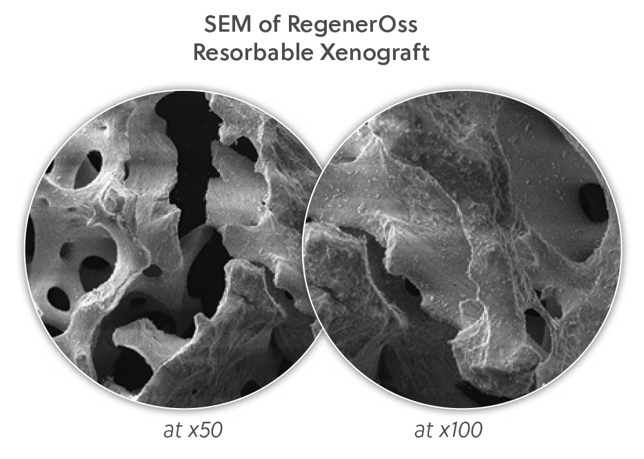 SEM of RegenerOss  Resorbable Xenograft at x50 and x100