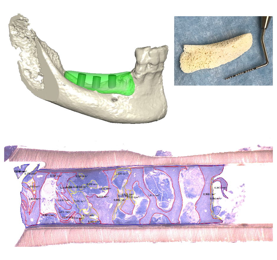 Case Report on Puros® Allograft Customized Bone Blocks for Ridge Reconstruction Case Report on Puros® Allograft Customized Bone Blocks for Ridge Reconstruction