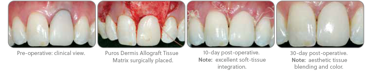 PUROS® DERMIS ALLOGRAFT A Variety of Clinical Advantages PUROS® DERMIS ALLOGRAFT A Variety of Clinical Advantages