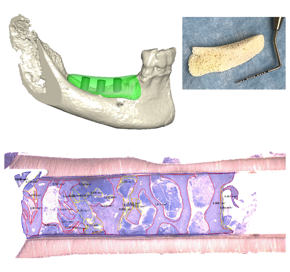 Case Report on Puros® Allograft Customized Bone Blocks for Ridge Reconstruction