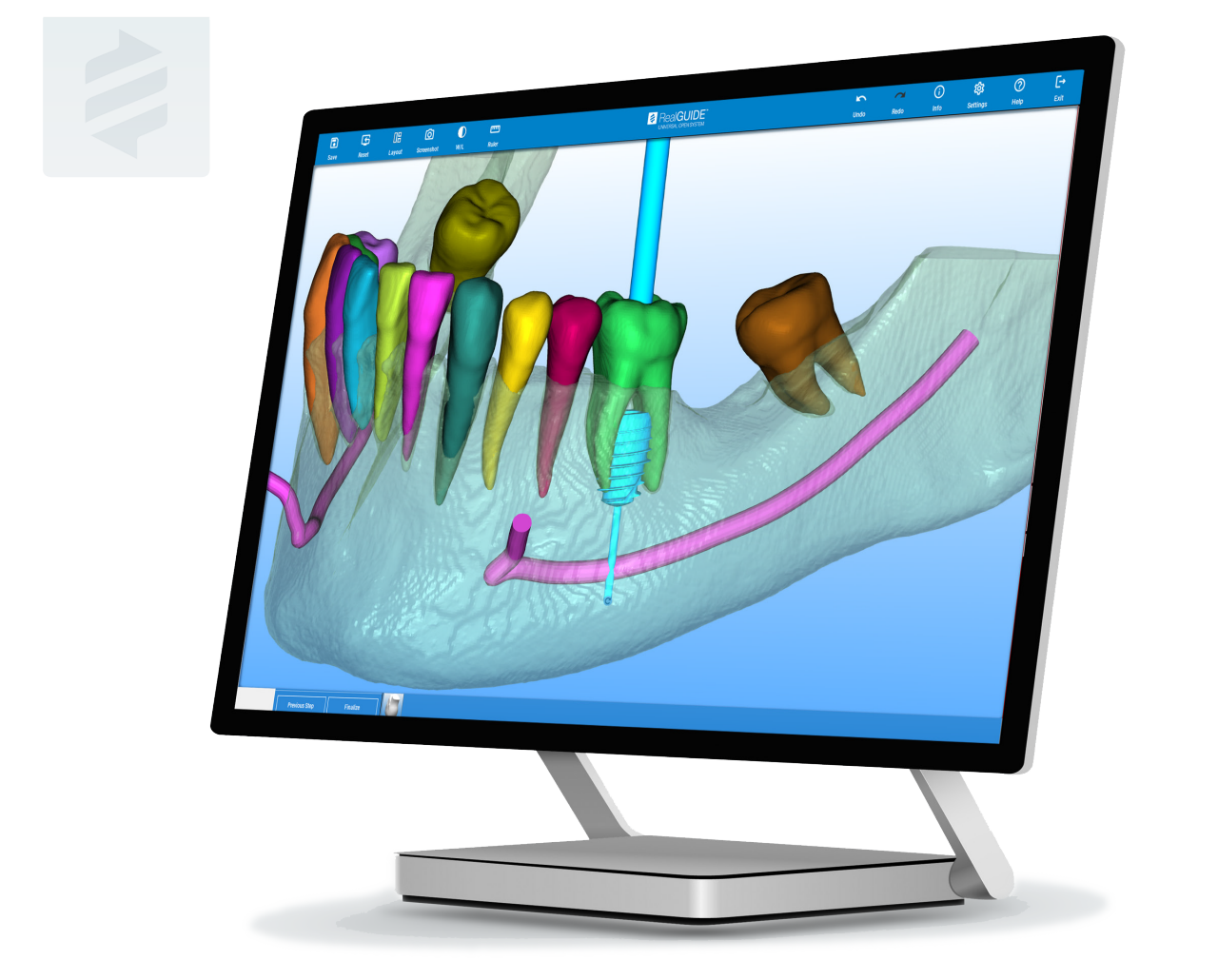A computer screen displaying ZimVie RealGUIDE® surgical planning software, showing a 3D digital model of the jaw with highlighted teeth and implant placement pathway for immediate molar implants, supporting precise and safe surgical planning.