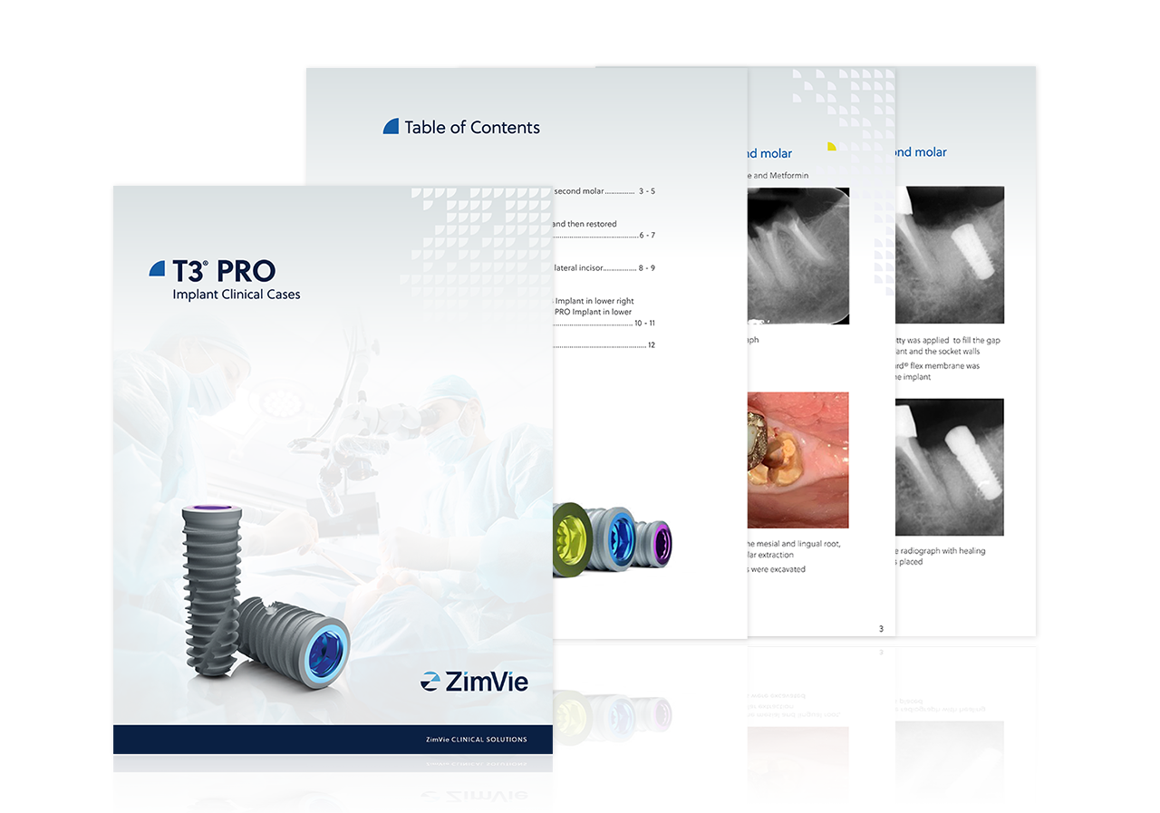 T3 PRO dental implant clinical cases