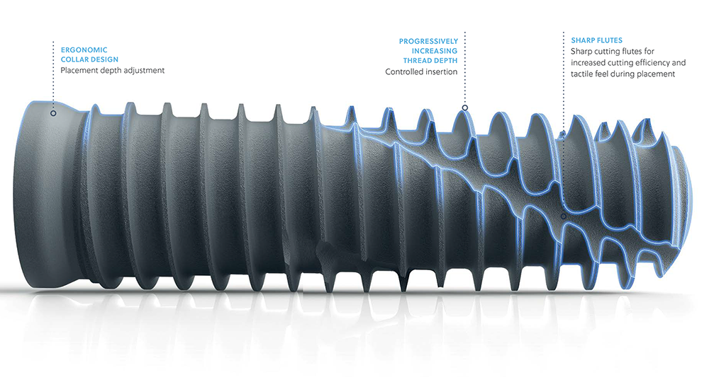 OverdenSURE Abutments