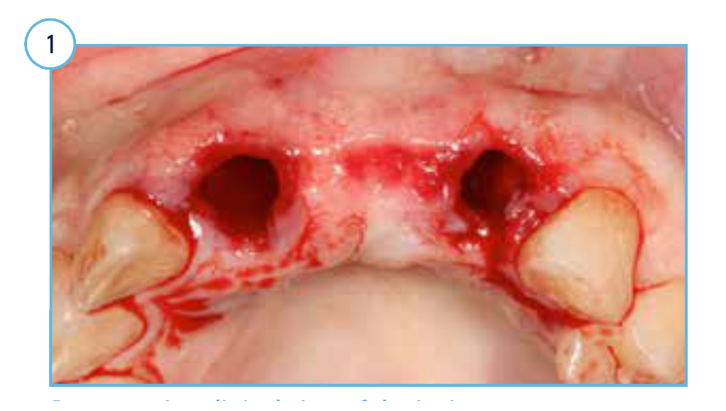 Case Study TSV - 1 Preoperative clinical view of the incisor extraction sockets.