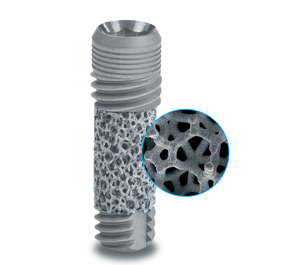 TM Implant