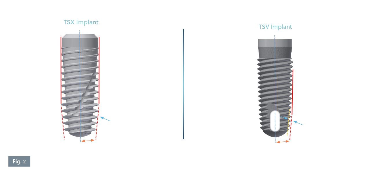 CAD Comparison of TSX® vs. TSV® Dental Implants Digital CAD models of the ZimVie TSX® implant (left) and TSV® implant (right), both 4.7mm x 13mm. The image highlights design differences: TSX features a 0.64mm apical thread depth and a 6° taper, while TSV shows a 0.35mm apical thread depth and a 5° taper. Colored lines indicate major and minor diameter tapers, and arrows emphasize thread depth for comparison.