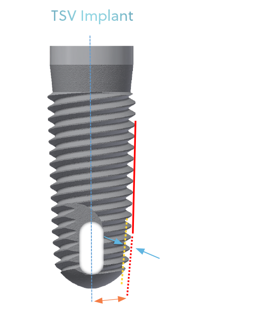 TSX® Dental Implant
