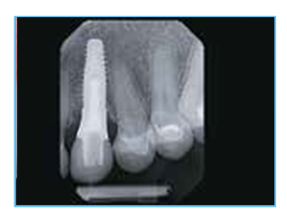  A close-up view of the IPS e.max glass-ceramic crowns and the BellaTek Gold-Colored Nitride Coated Abutment that were custom-fabricated for the case.