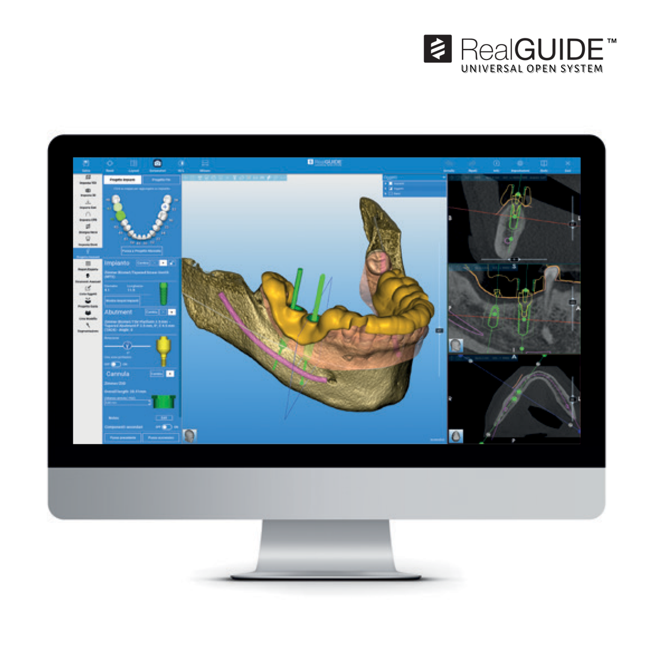 Computer monitor displaying 3D dental implant planning software from the RealGUIDE Software Suite, an in-house solution for both clinicians and laboratories. The system supports diagnosis, surgical guide design, and customized drilling reports to optimize dental implant therapy.