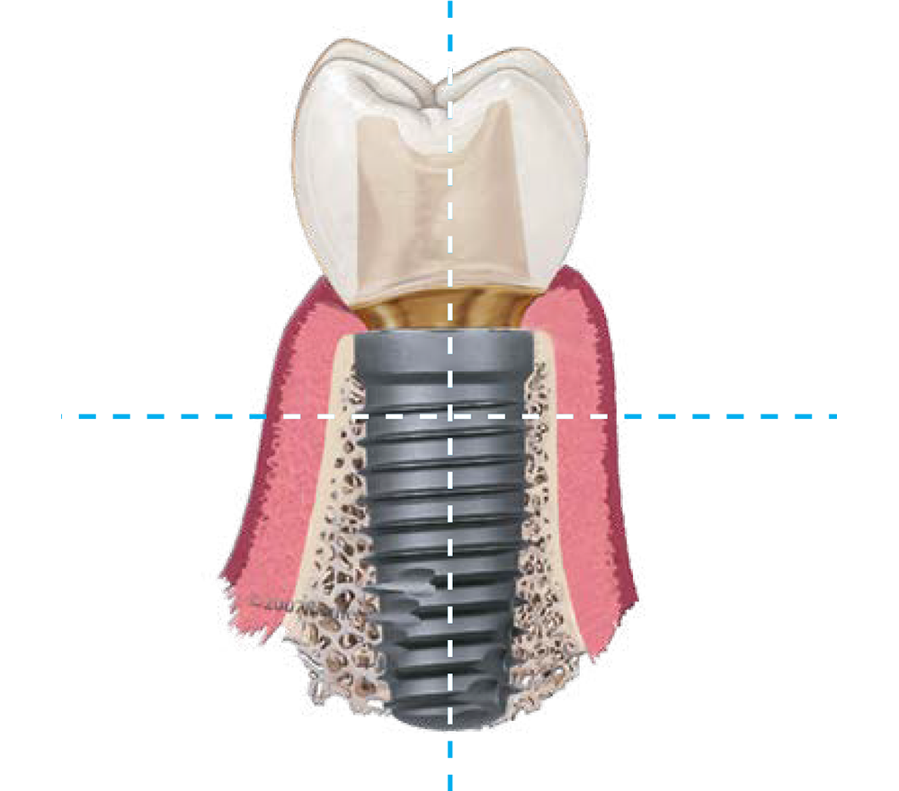 A dental implant and  implant crown are  designed to mimic the look, feel, and function of a natural tooth.