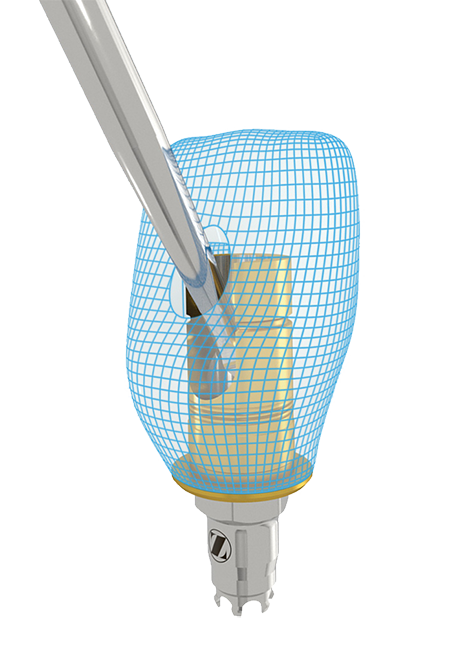 Express and Flex Abutments