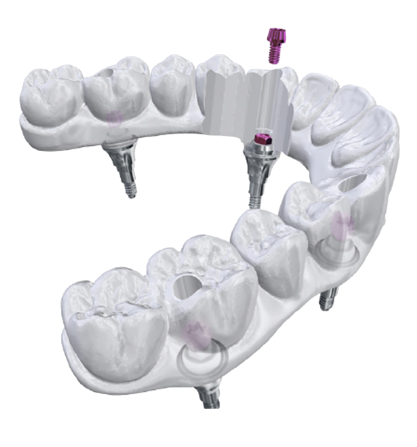 3D illustration of a full-arch restoration secured with ZimVie All-on-X (AOX) Screws in a direct-to-Multi-Unit Abutment workflow. The image demonstrates improved restorative thickness, elimination of Ti-Bases, and enhanced force distribution for predictable zirconia and temporary full-arch restorations.