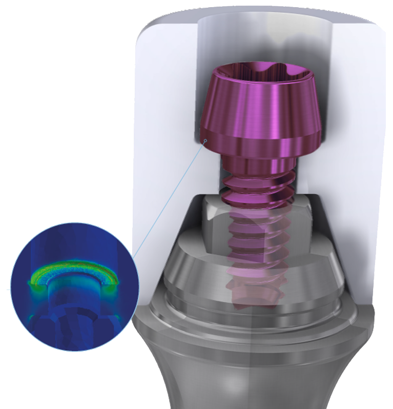 Close-up rendering of the ZimVie All-on-X (AOX) Screw seated on a Multi-Unit Abutment, highlighting the flat seat design, increased restorative thickness, self-centering feature, Torx ball angulation up to 25°, and gold anodized finish for identification. The image illustrates improved force distribution and reduced screw loosening for predictable full-arch restorations.