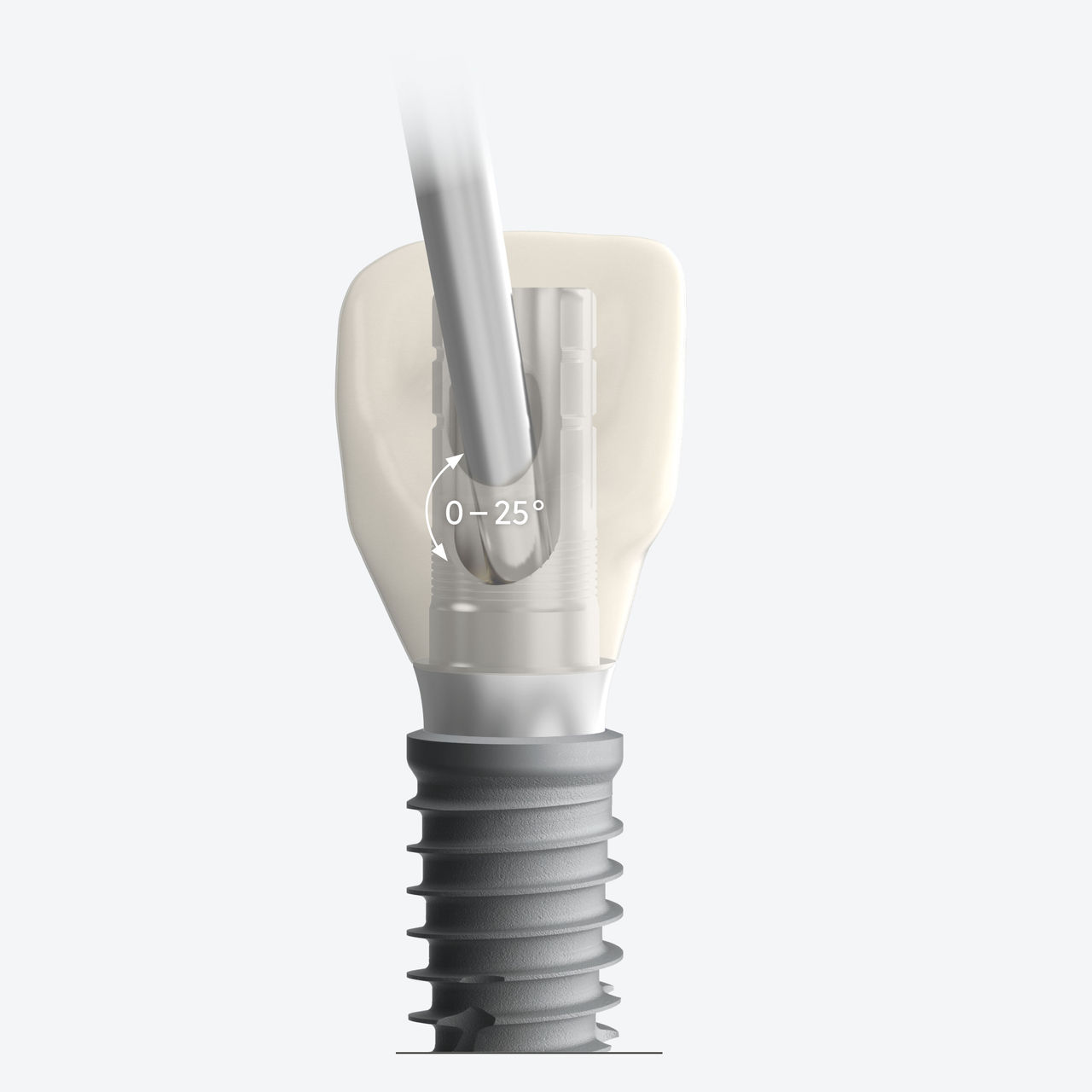 GenTek Abutments Enabled Angles for Versatility 