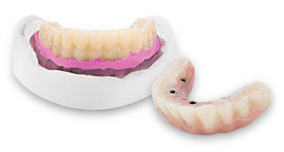 Image of a dental model featuring a pink soft-tissue mimic and a removable prosthetic restoration, showcasing precision fit for dental implant procedures.