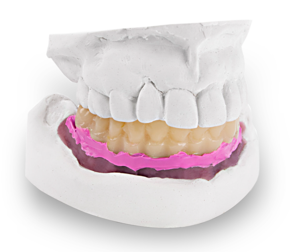 A dental cast displaying an upper and lower arch with a prosthetic denture seated in pink impression material. The model demonstrates accurate implant-supported prosthesis fitting and lab fabrication for restorative dentistry.