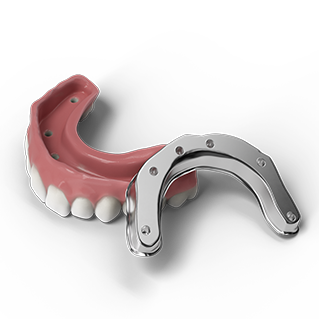 ZimVie BellaTek Bars and Frameworks