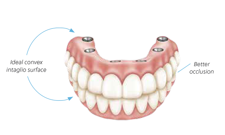 Create better contours without the need to unnecessarily bulk the prosthesis. Improve occlusion by utilizing a fully occluded pickup technique, reducing the need for major occlusal adjustments.