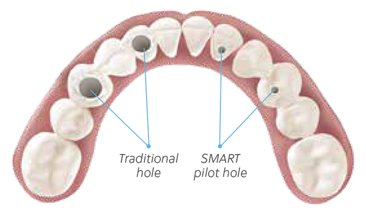 Engaging in implant, not for use in single-unit restorations