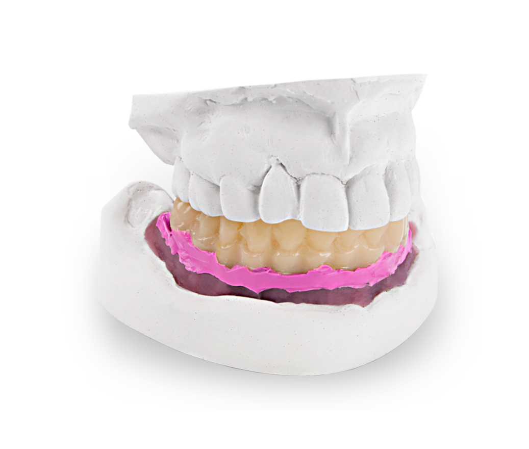 Dental Model with Prosthetic Denture and Impression A dental cast displaying an upper and lower arch with a prosthetic denture seated in pink impression material. The model demonstrates accurate implant-supported prosthesis fitting and lab fabrication for restorative dentistry.
