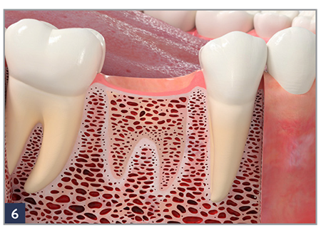 Place a RegenerOss Bone Graft Plug immediately after an extraction.