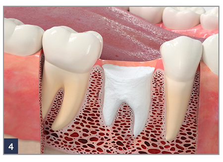 Place a RegenerOss Bone Graft Plug immediately after an extraction.