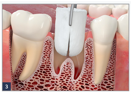 Place a RegenerOss Bone Graft Plug immediately after an extraction.