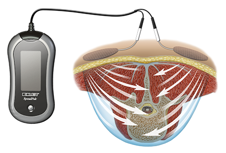 SpinalPak Stimulator System How it Works Illustration