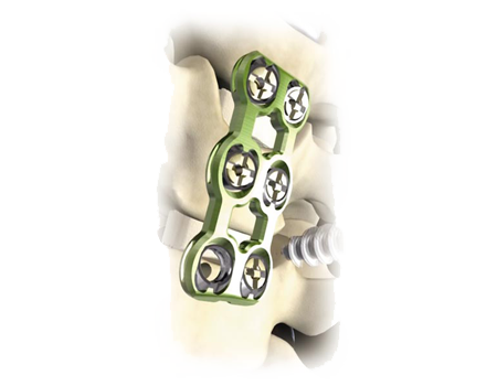 MaxAn® Anterior Cervical Plate System