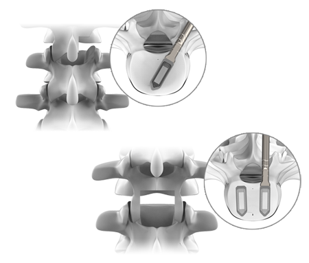 TrellOss TS Implant in Spine
